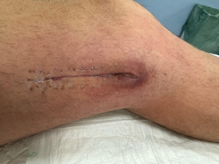 Alberto Durán, de nouveau hospitalisé d'urgence en raison de « une forte fièvre et une infection » à la jambe